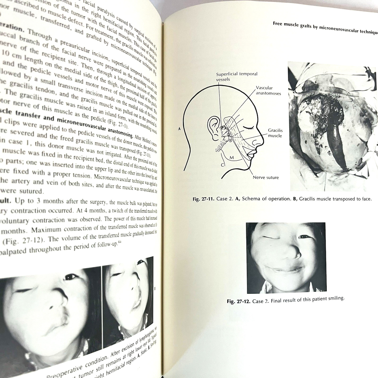 Vintage Reanimation of The Paralyzed Face Book Hardcover Leonard R. Rubin 1977