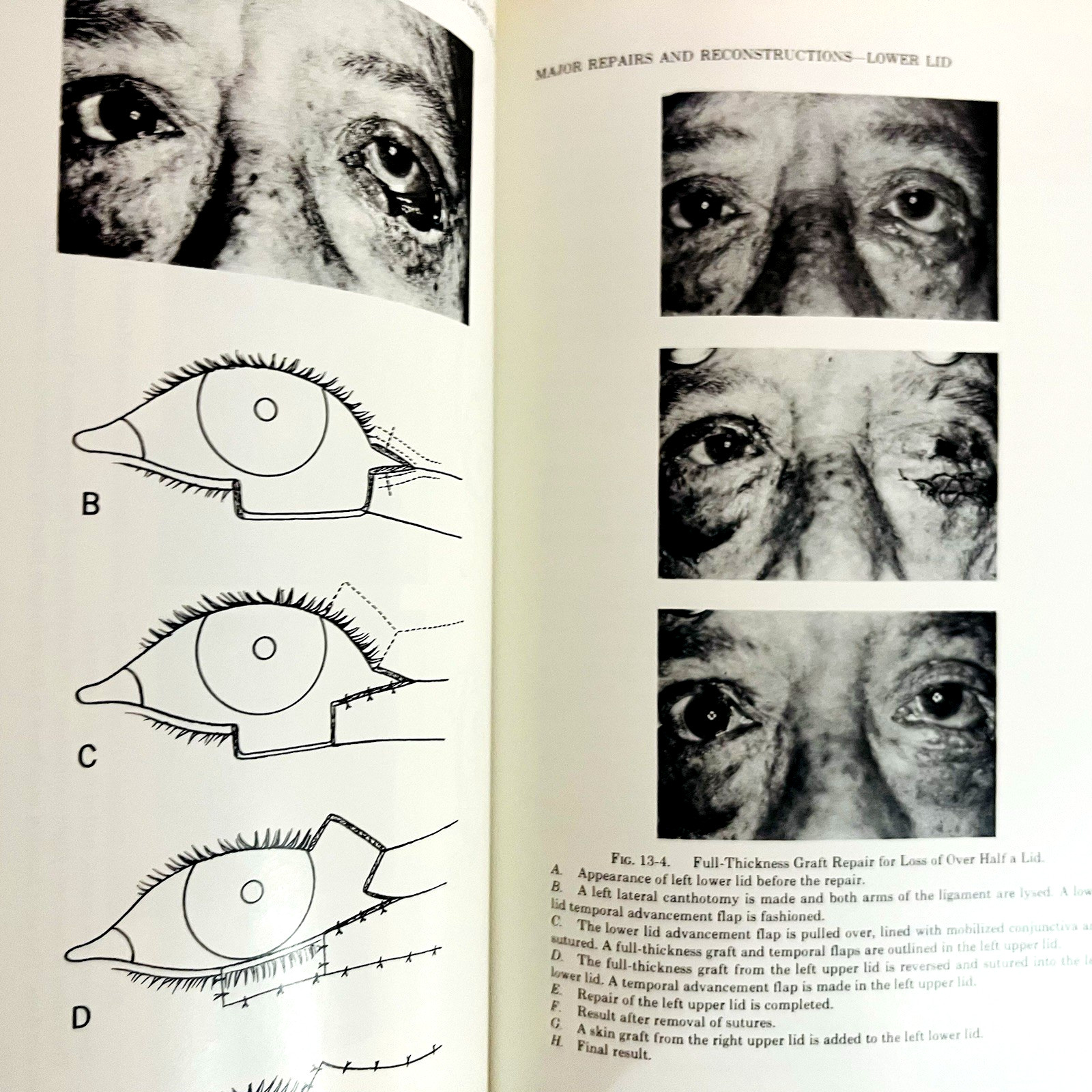 Ophthalmic Plastic Surgery Fifth Edition Book Hardcover Sidney A. Fox 1976