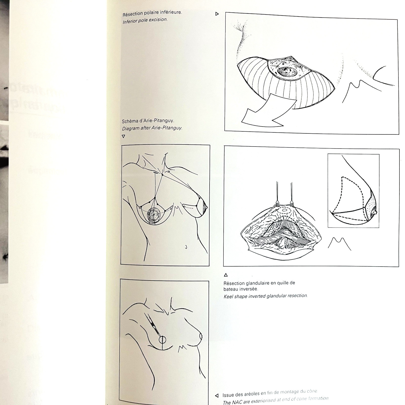 Plastic Reconstructive Breast Surgery French Chirurgie Du Sein Book 1983