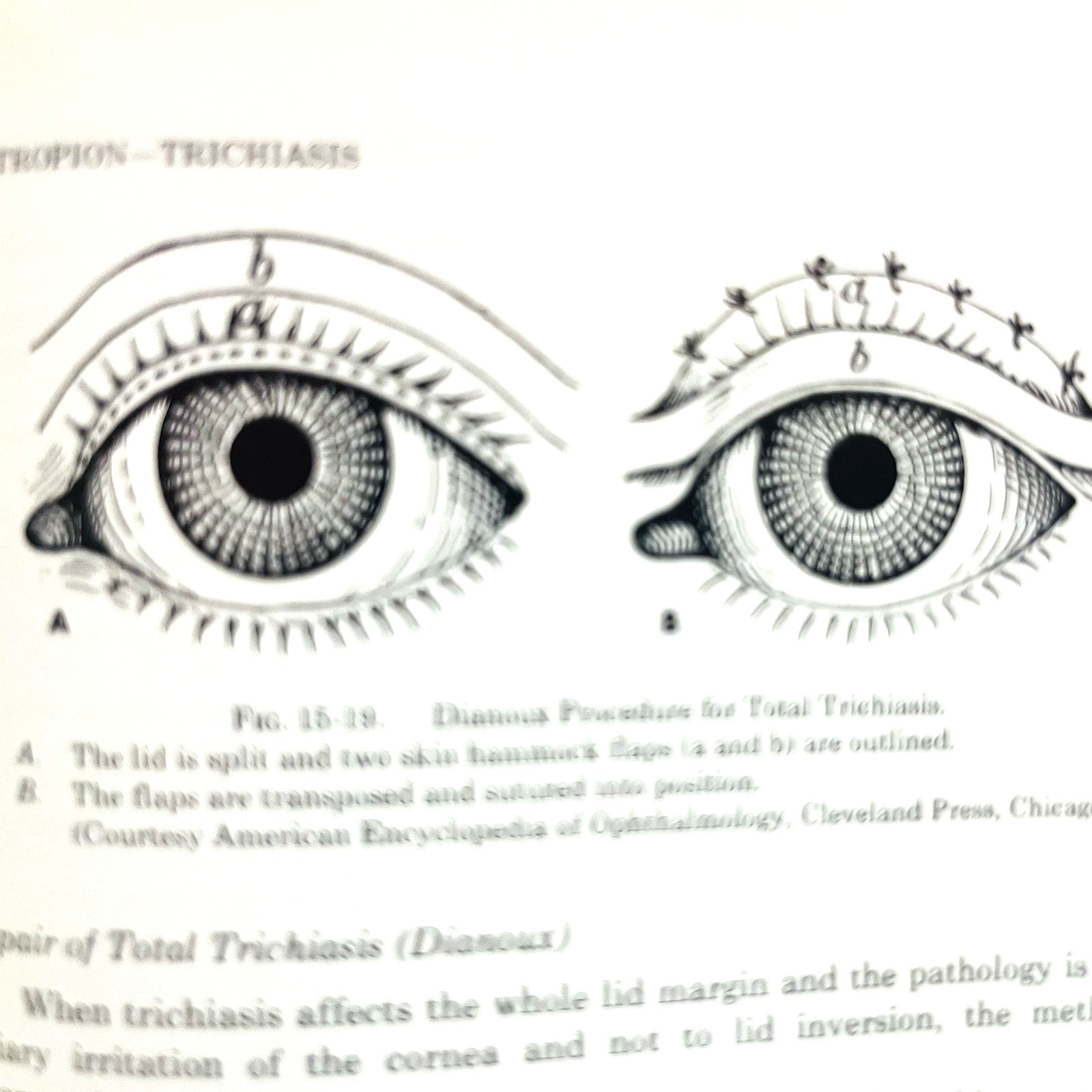 Ophthalmic Plastic Surgery Fifth Edition Book Hardcover Sidney A. Fox 1976