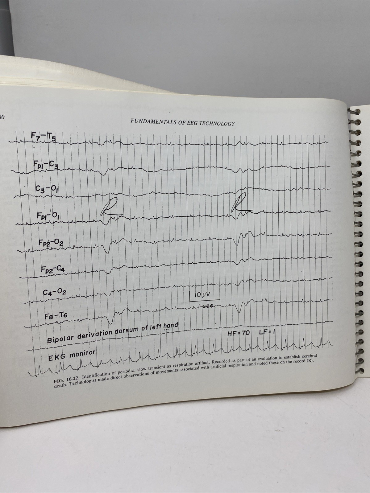 Fundamentals EEG Technology Vol 1 Tyner Spiral Bound 1985 Raven Press Lippincott