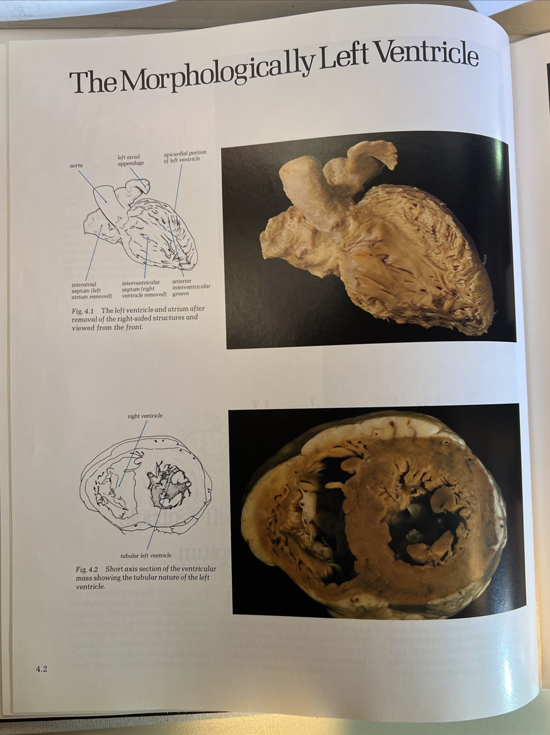 Cardiac Anatomy: An Integrated Text and Color Atlas by Robert Anderson- 1980 -B2