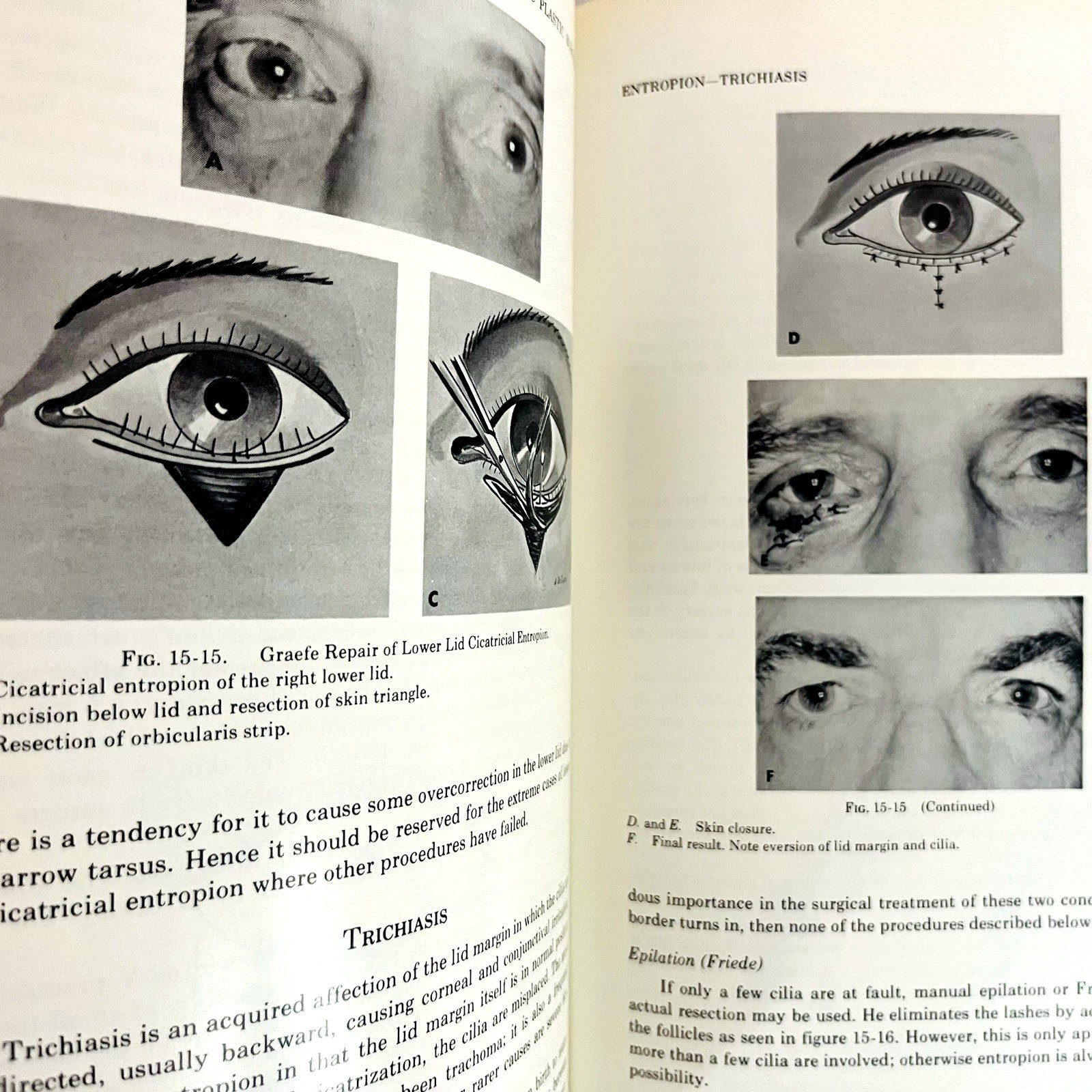 Ophthalmic Plastic Surgery Fifth Edition Book Hardcover Sidney A. Fox 1976