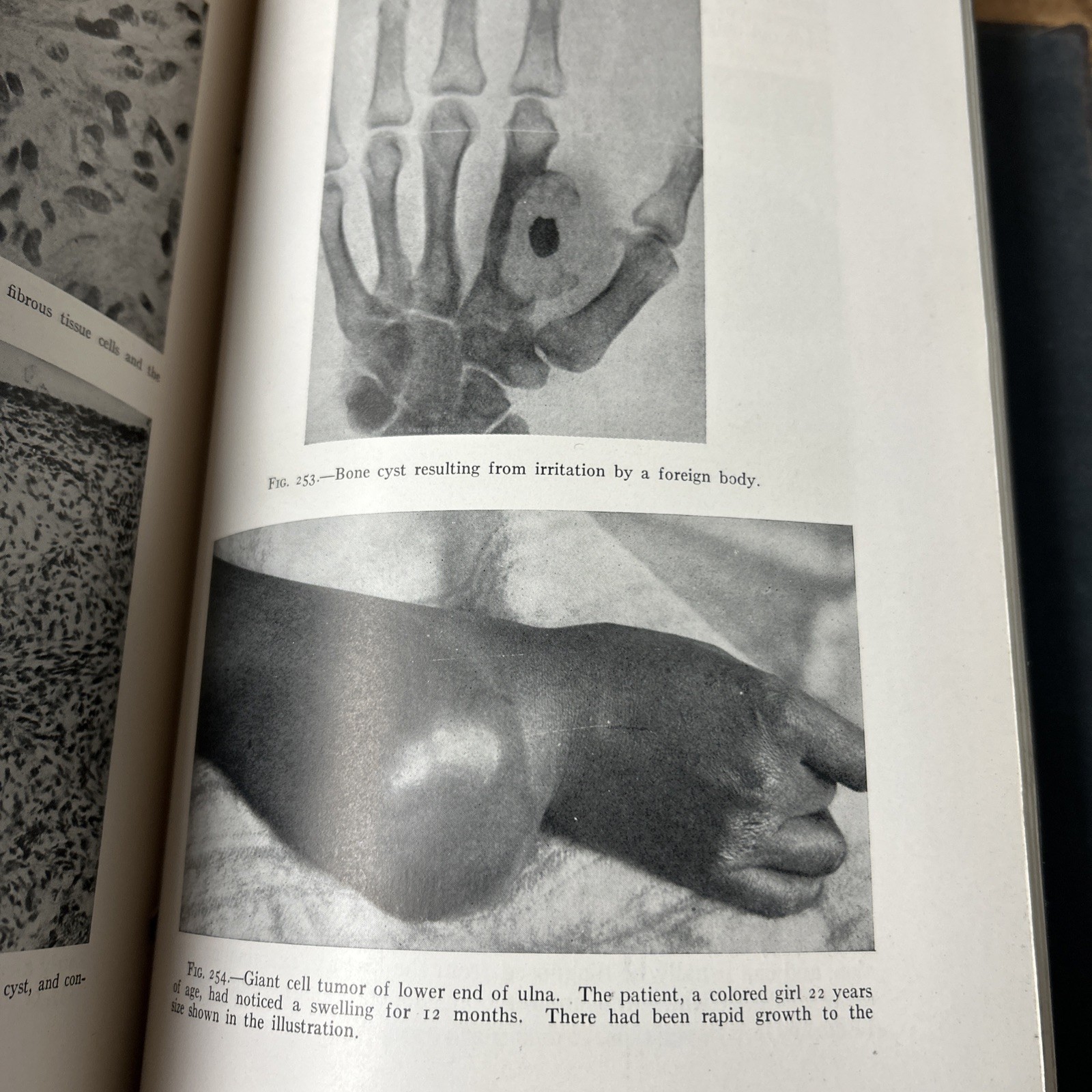 Practice Of Surgery V – Dean Lewis 1930 Pulmonary Lung Chest Plastic Surgery
