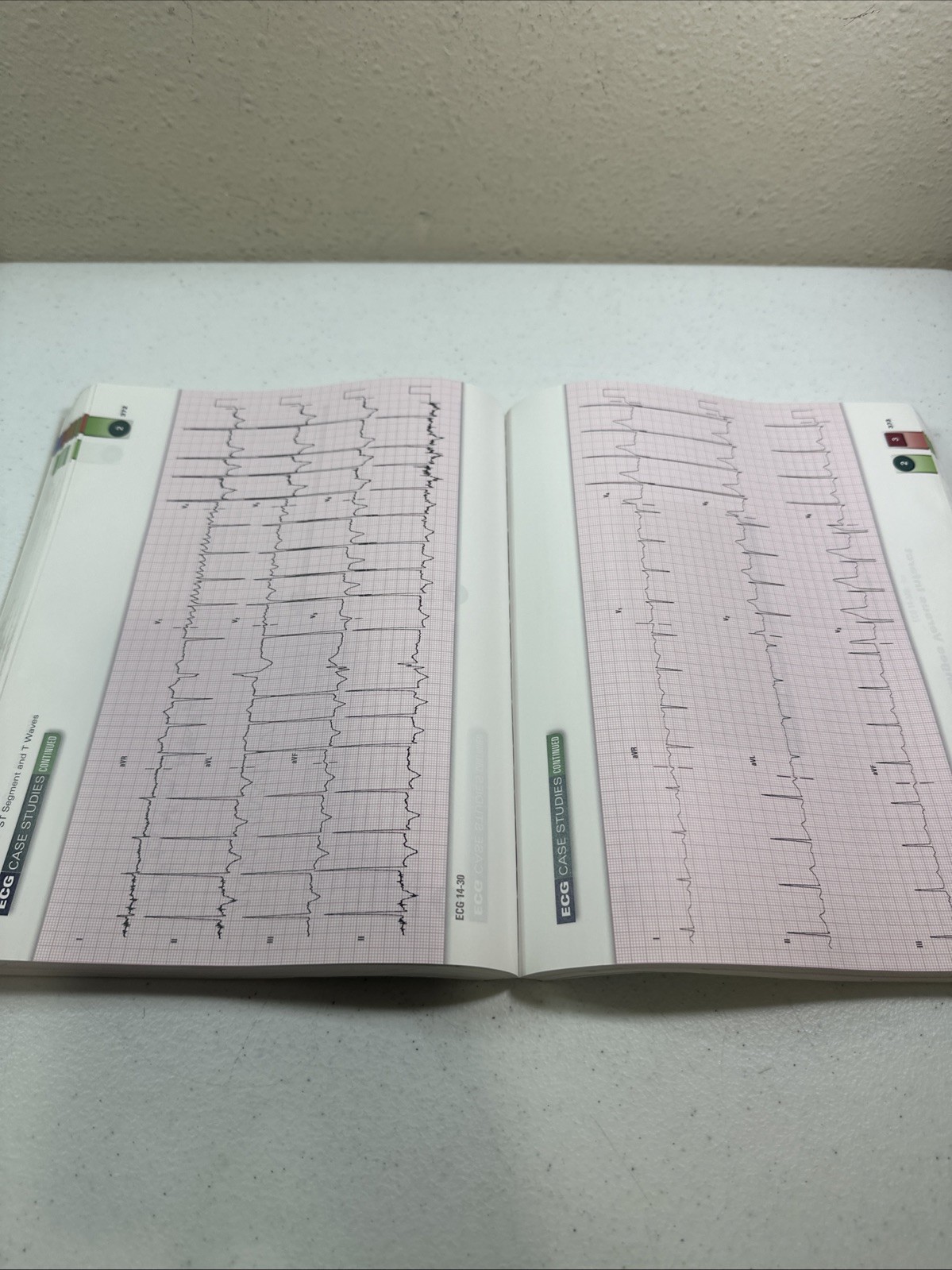 12-Lead ECG The Art Of Interpretation 2nd Edition Tomas B Garcia 2015 Paperback